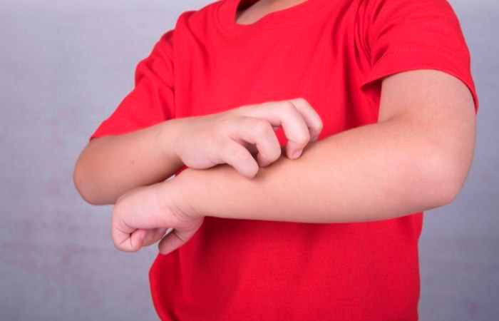 Niño rascándose un brazo por alergia al látex