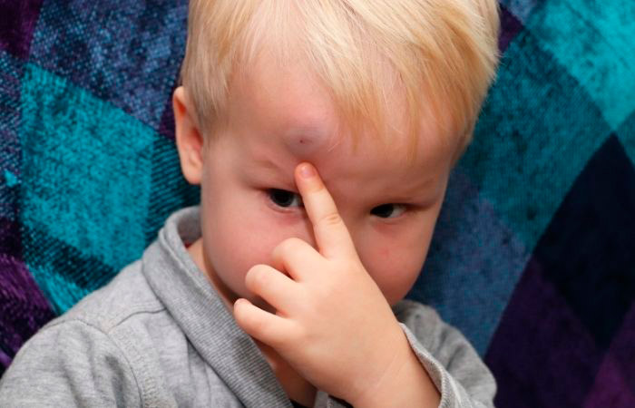 Curar los chichones: niño señala con su dedo un golpe en la frente