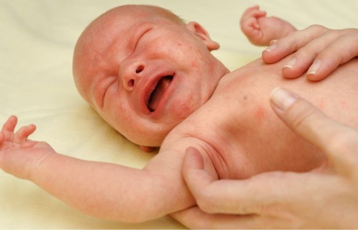 Acné en bebés: valoración del médico