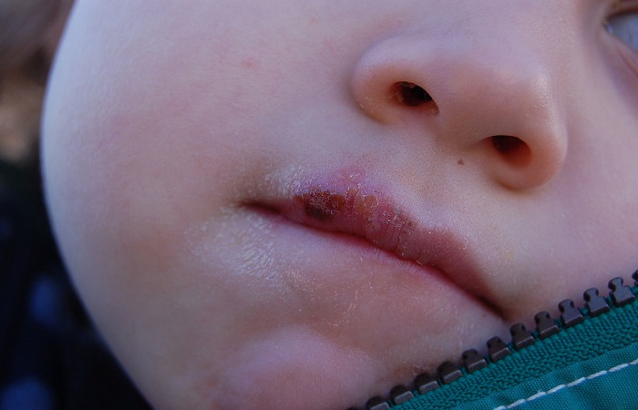 Tipos de herpes en niños: ¿qué síntomas los caracterizan y cómo podemos prevenirlos y tratarlos?