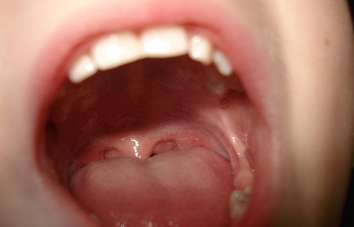 Gingivoestomatitis por herpes en niños