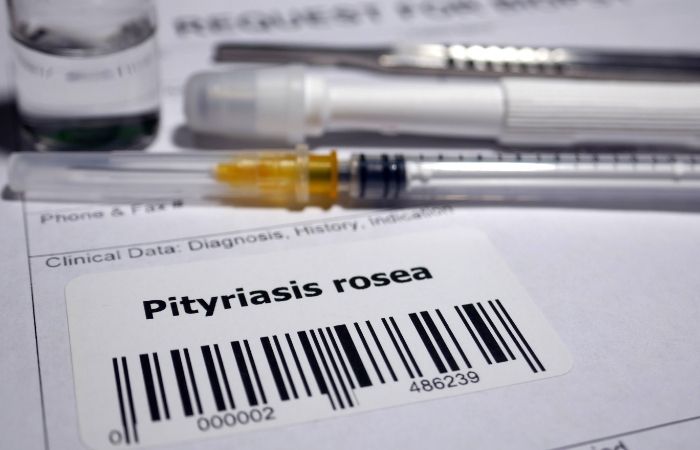 Pitiriasis rosada: tratamientos