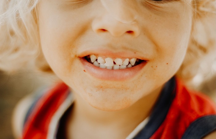 golpes en los dientes: niño con con un incisivo de leche roto